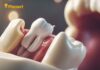 Gentle Wisdom Teeth Extraction in Pincourt You Can Trust